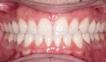Adrian after Smile Express Treatment
