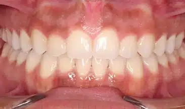 Briana after Smile Express Treatment