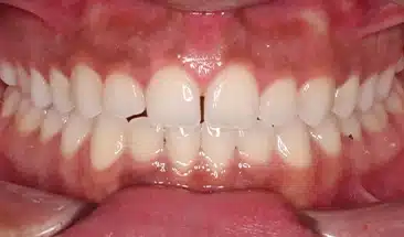 Briana before Smile Express Treatment