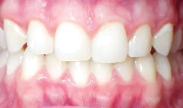 Denise after Smile Express Treatment