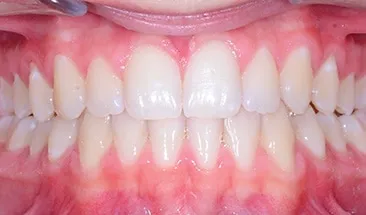 Jerrod after Smile Express Treatment