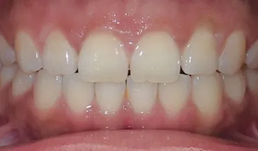 Larry after Smile Express Treatment